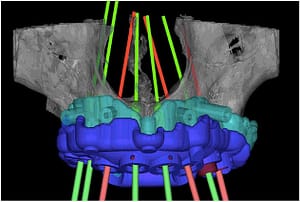 Planificación y diseño All-on-X