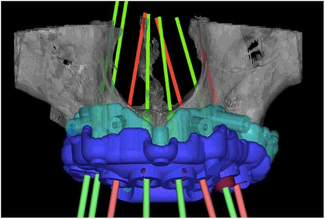 Planificación y diseño All-on-X