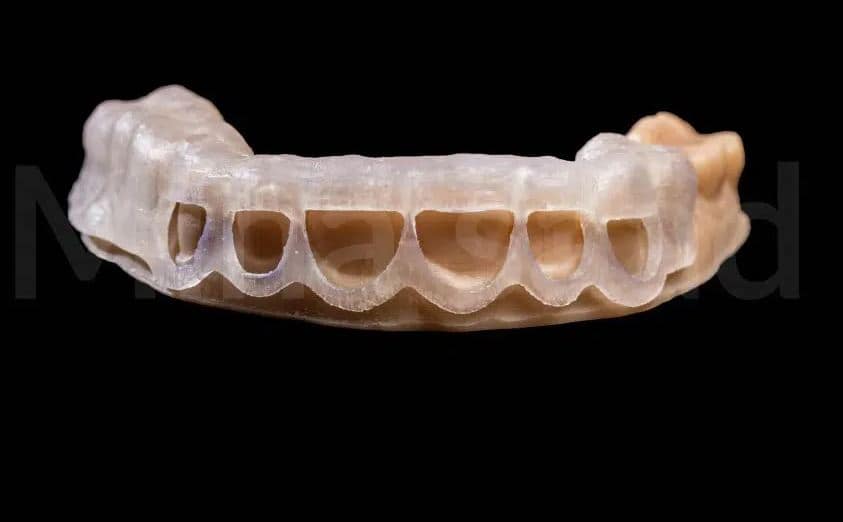 Diseño de Férula Doble de Alargamiento Coronario