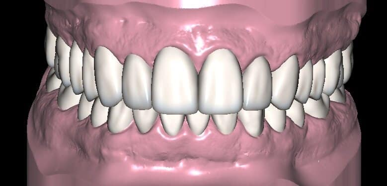 Bono Diseño de Sonrisa