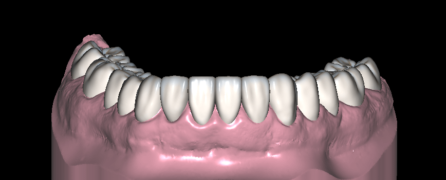 Diseño de Sonrisa Inferior