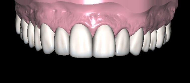 Diseño de Sonrisa Superior